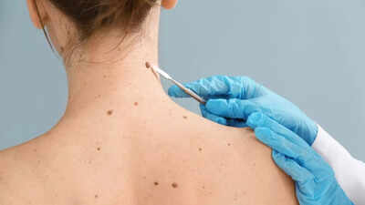 7 early symptoms of cancer that often get dismissed as minor illnesses |