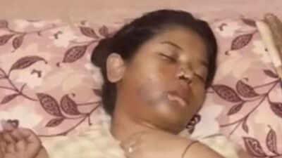 Cheek split in 2 parts: BBA student attacked by stray dogs in Kanpur; receives 17 stitches | Kanpur News