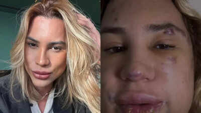 Brazilian social media influencer Junior Dutra dies at 31 after fox eyes cosmetic surgery complications; sparking safety concerns over trendy procedures |