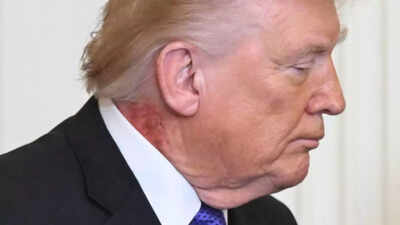 Donald Trump appears with red rash on neck – his doctor explains what happened