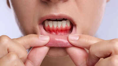 Gum Health: Bleeding gums may signal more than oral disease: How gum health is linked to heart risk and inflammation |