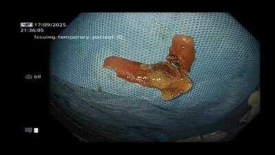 Laser saves man after denture gets stuck in food pipe | India News